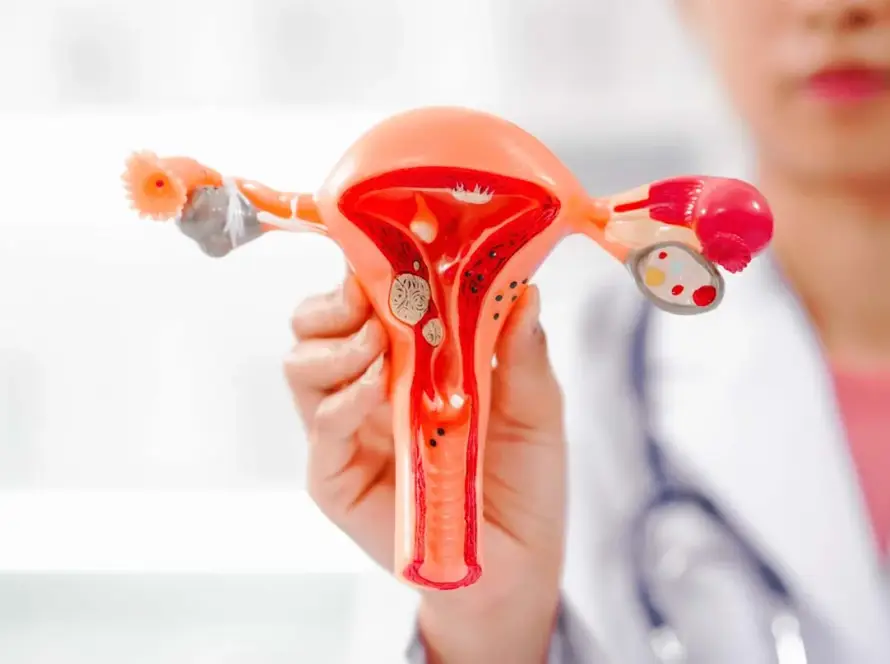 Ινομυώματα