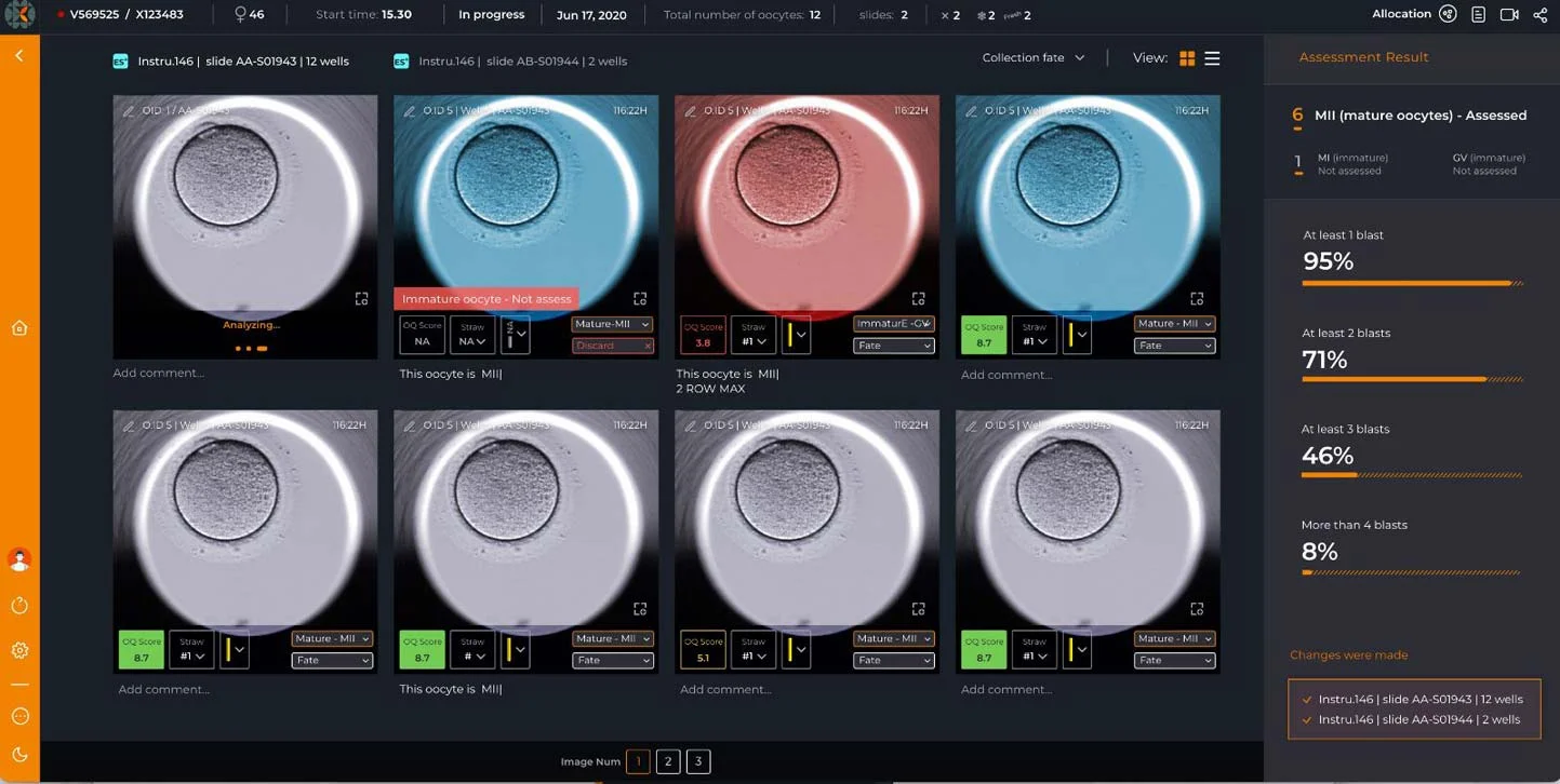 CHLOE OQ - Τεχνητή νοημοσύνη AI στην Υποβοηθούμενης Αναπαραγωγής (IVF)